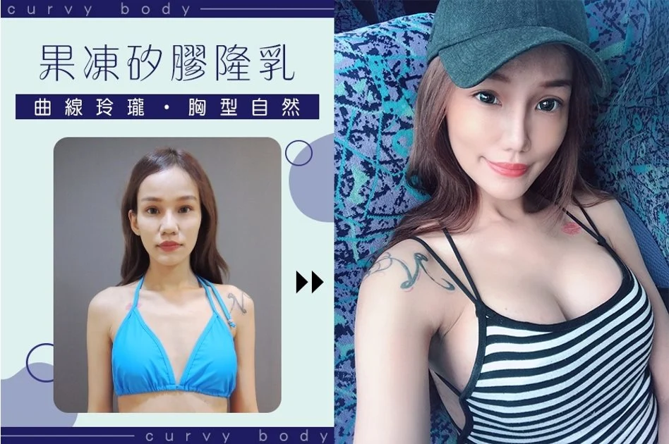 魔滴隆乳,觸感柔軟胸型自然, 橫空出世的果凍矽膠隆乳